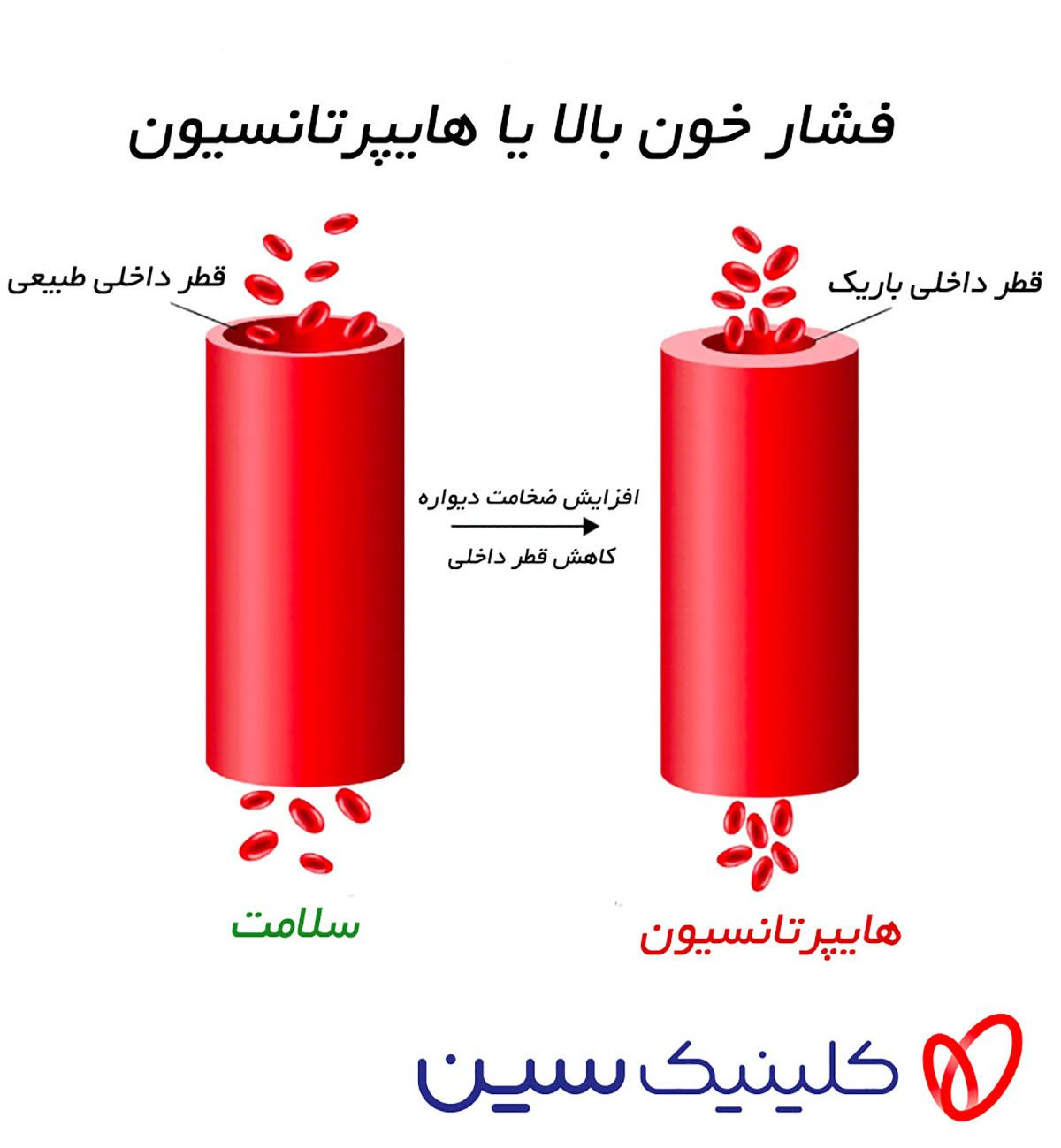 فشار خون بالا و عروق