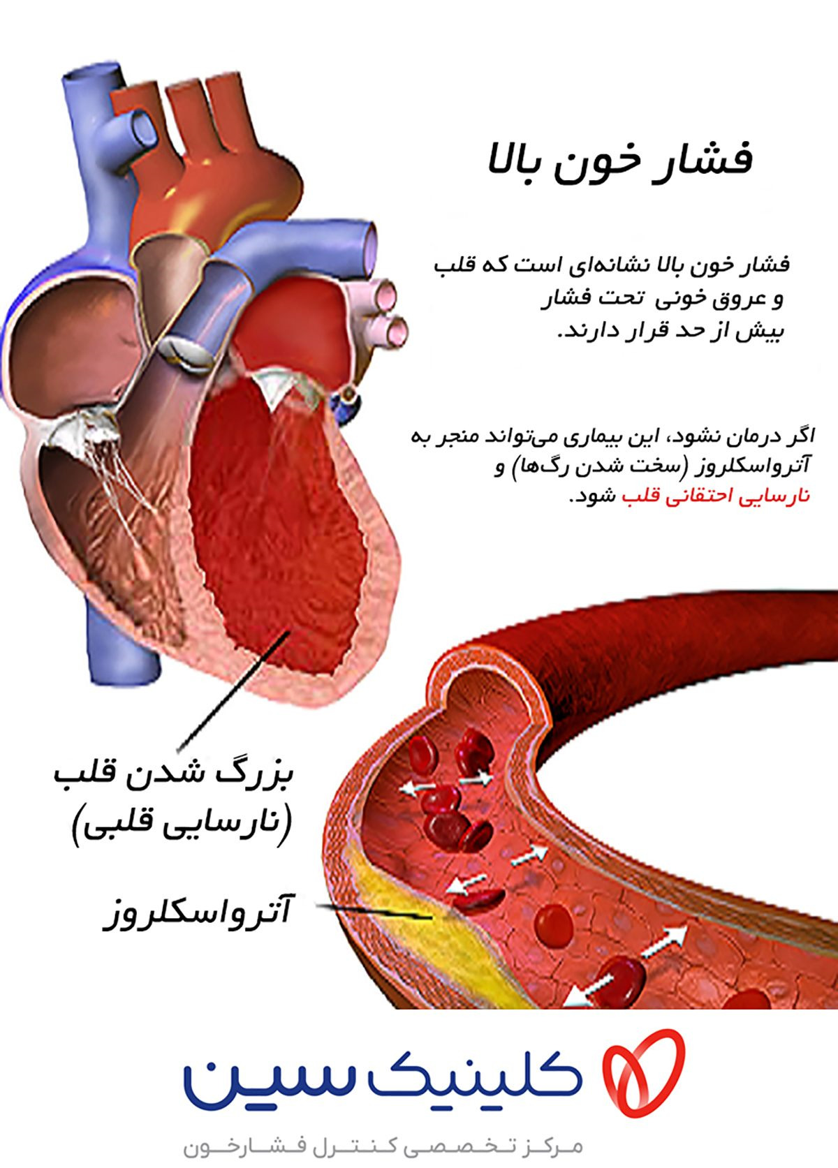 فشار خون بالا و نارسایی قلبی