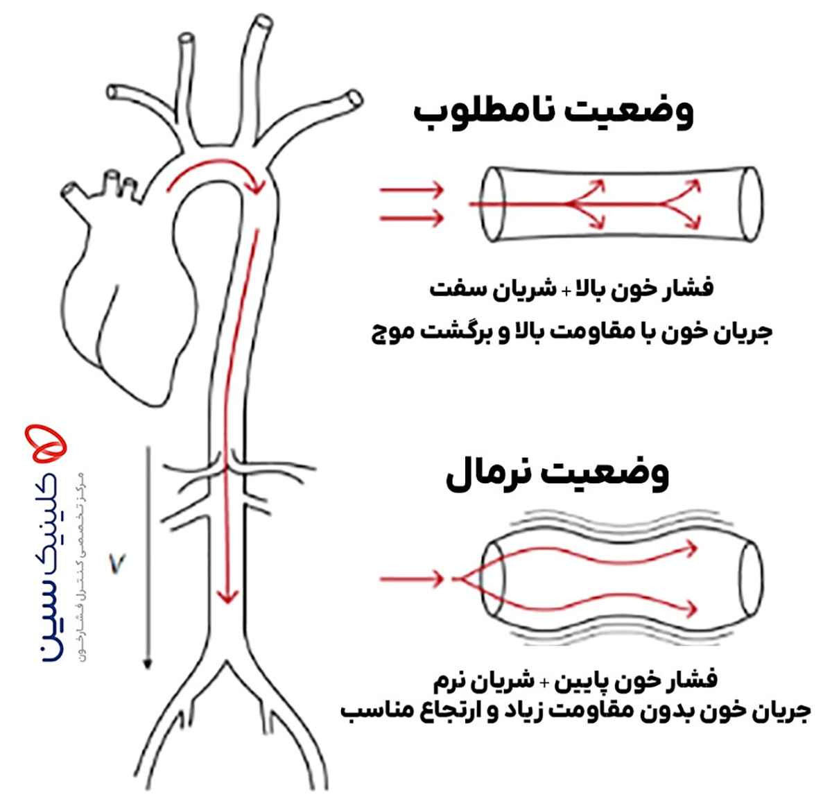 مقایسه وضعیت نرمال و نامطلوب جریان خون در آئورت؛ شریان نرم با ارتجاع مناسب در برابر شریان سفت با بازگشت موج و فشار بالا