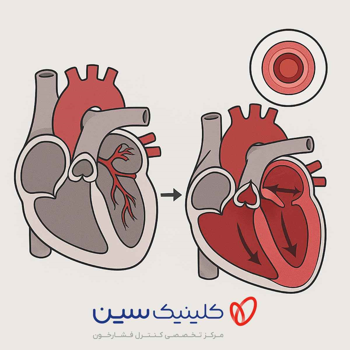 آسیب فشار خون