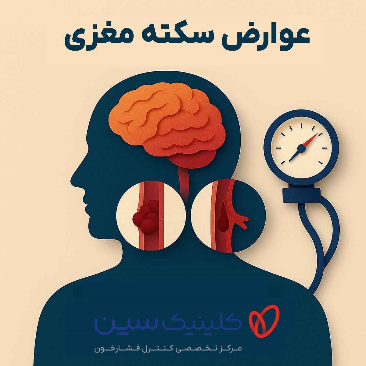 سکته مغزی
