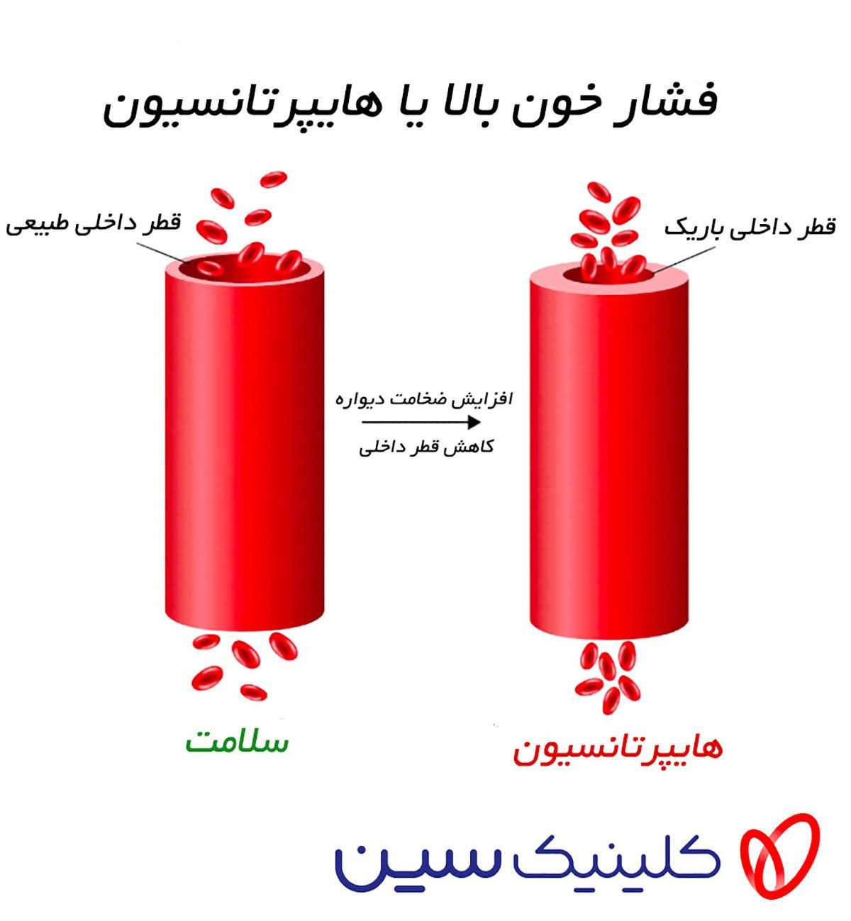 فشار خون بالا