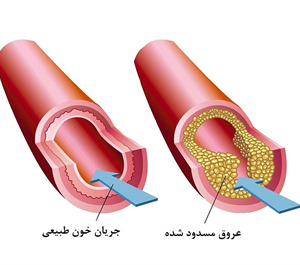 تنگ شدن رگ‌های بدن